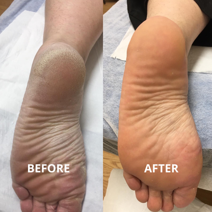 Foot stick for Dry & Callused Heels