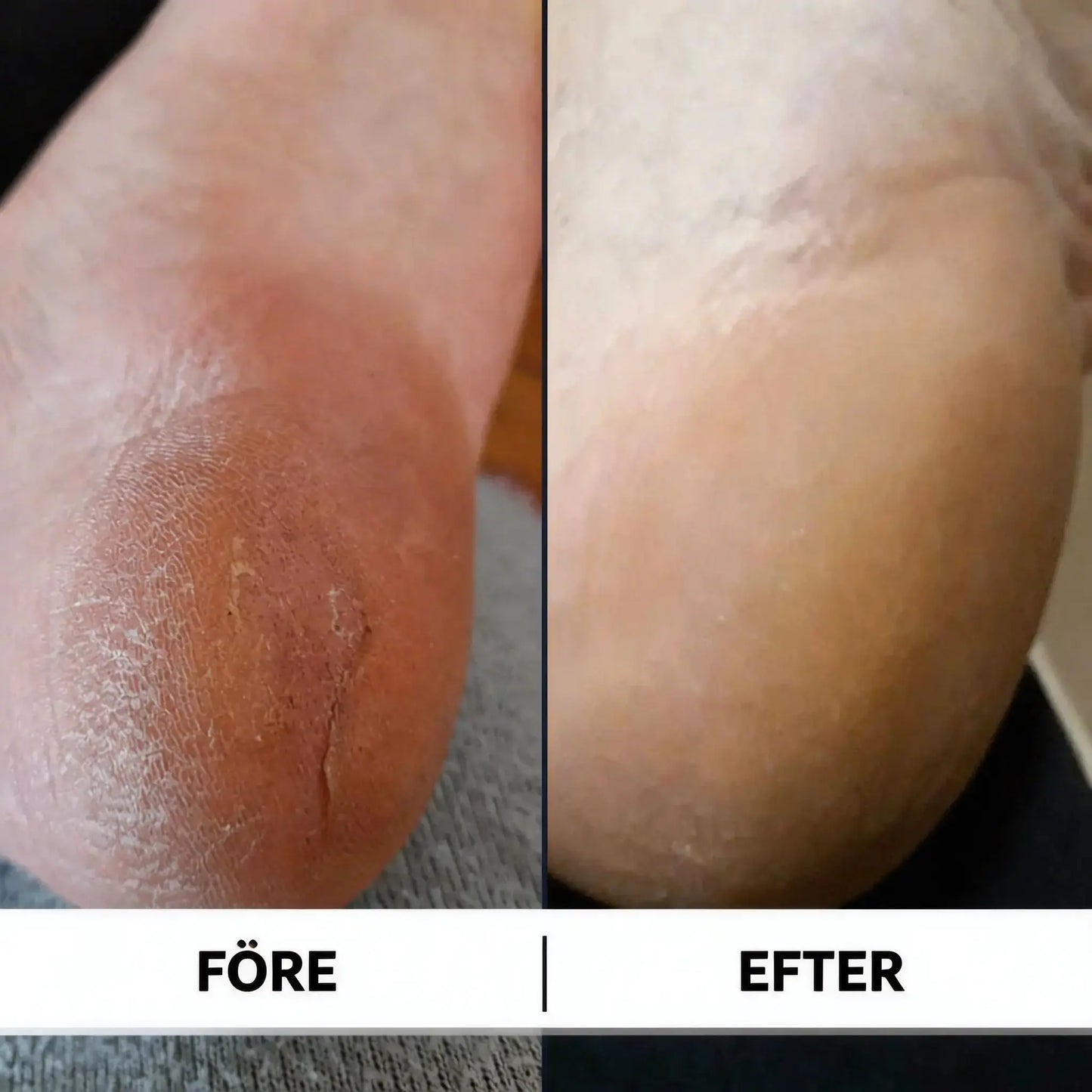 Före och efter behandling av spruckna hälar med 60% urea